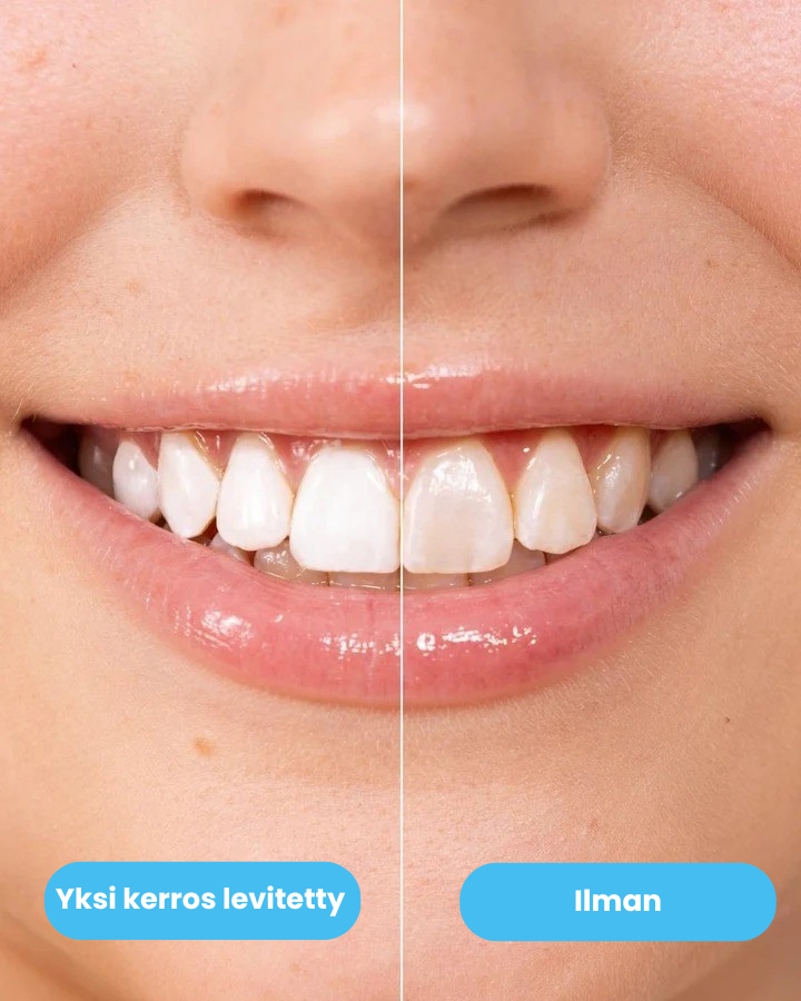 WhiteSmile- Välittömästi valkoisemmat hampaat