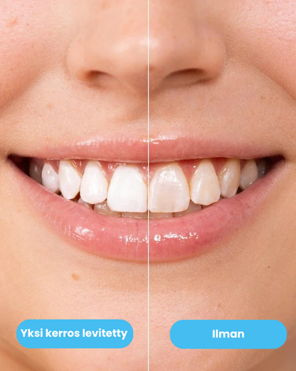 WhiteSmile- Välittömästi valkoisemmat hampaat